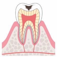 C2：象牙質のむし歯