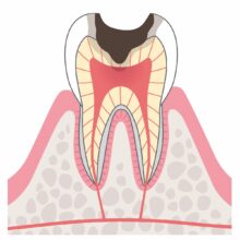 C3：歯の神経（歯髄）に達したむし歯
