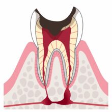 C4：歯根に達したむし歯