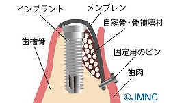 GBR法（骨造成誘導法）