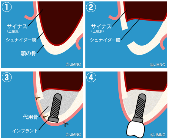 サイナスリフト法（上顎洞底挙上術）