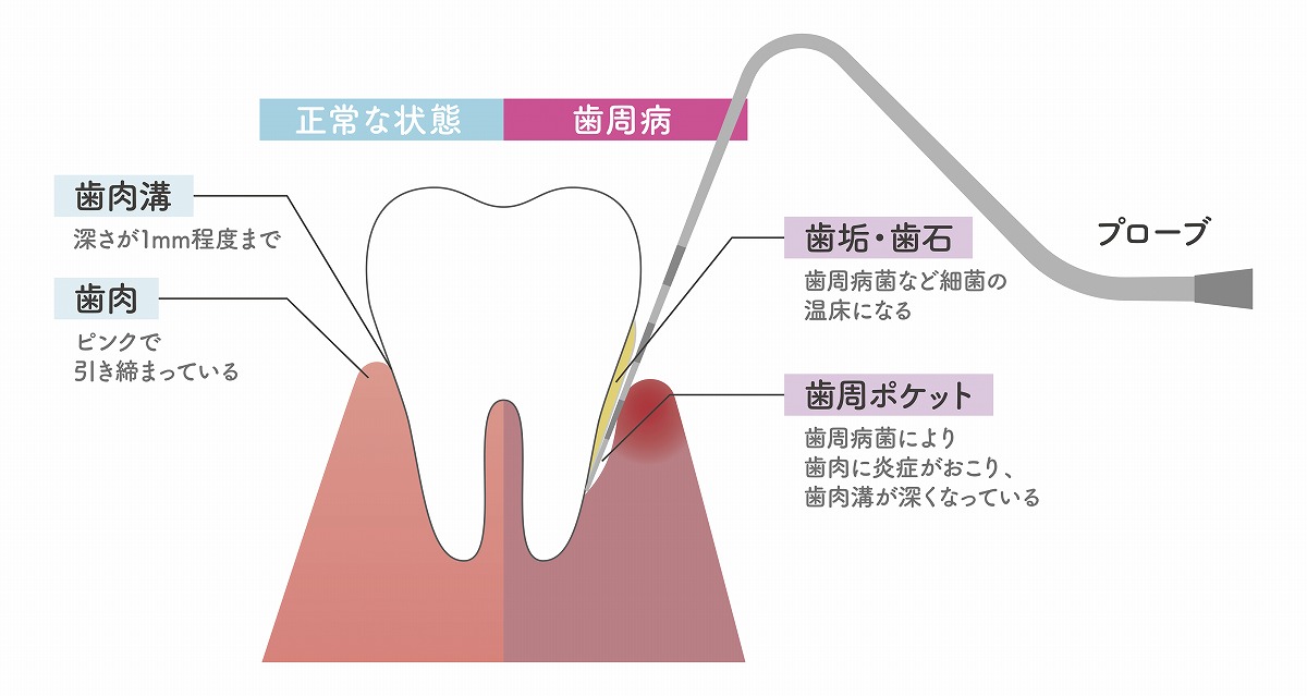 歯を失う可能性がある「歯周病」とは？
