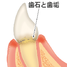 歯肉炎