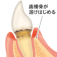 軽度歯周炎