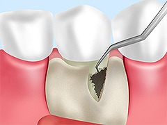歯周外科治療(フラップ手術)