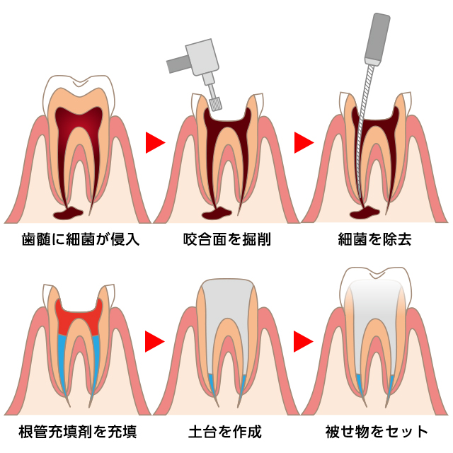 根管治療