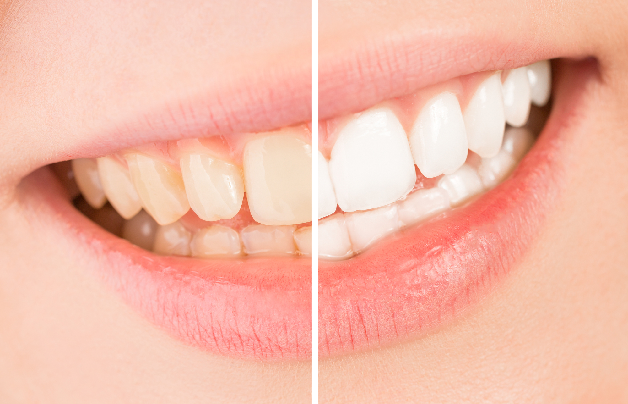 歯を白くするホワイトニングとは？